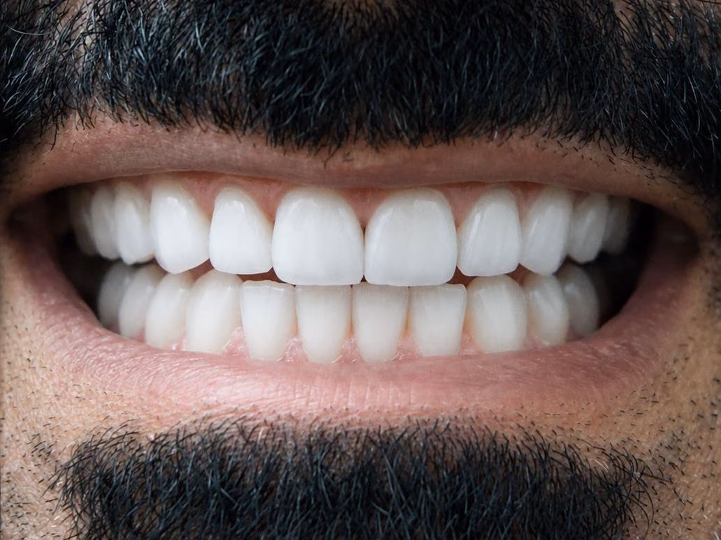 The same patient smiling after Hollywood Smile veneers at Burlington Dental Centre