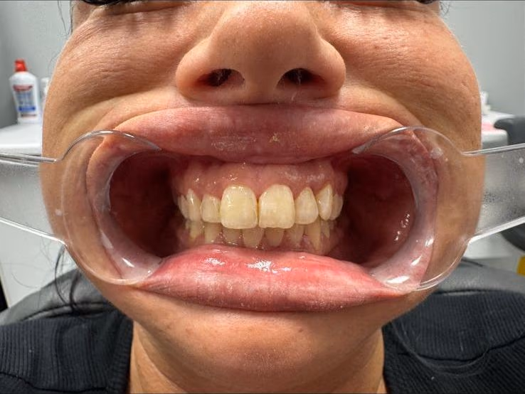 Discoloured, uneven teeth before Hollywood Smile treatment at Burlington Dental Centre