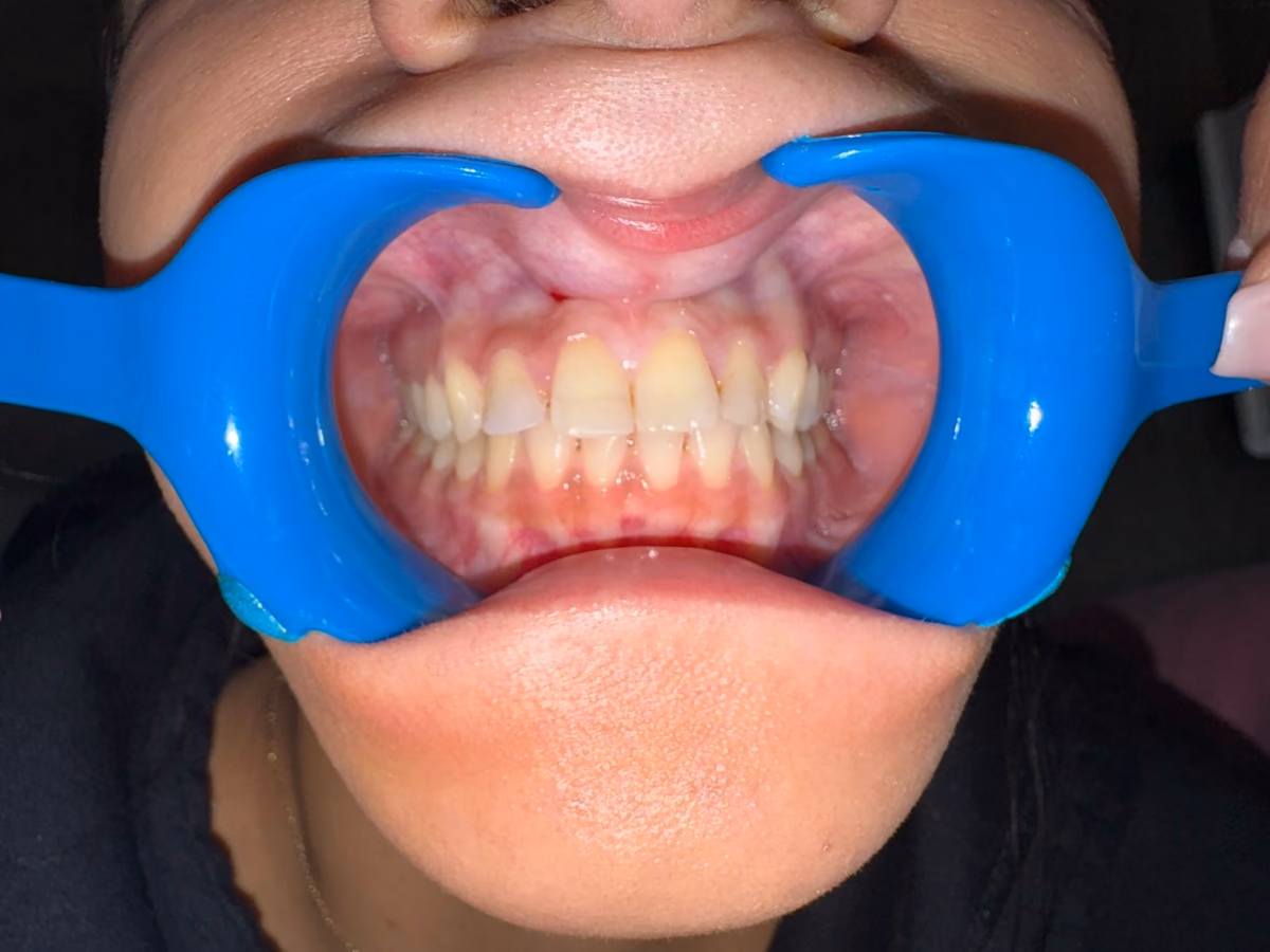 Uneven, discoloured upper teeth before Hollywood Smile treatment at Burlington Dental Centre