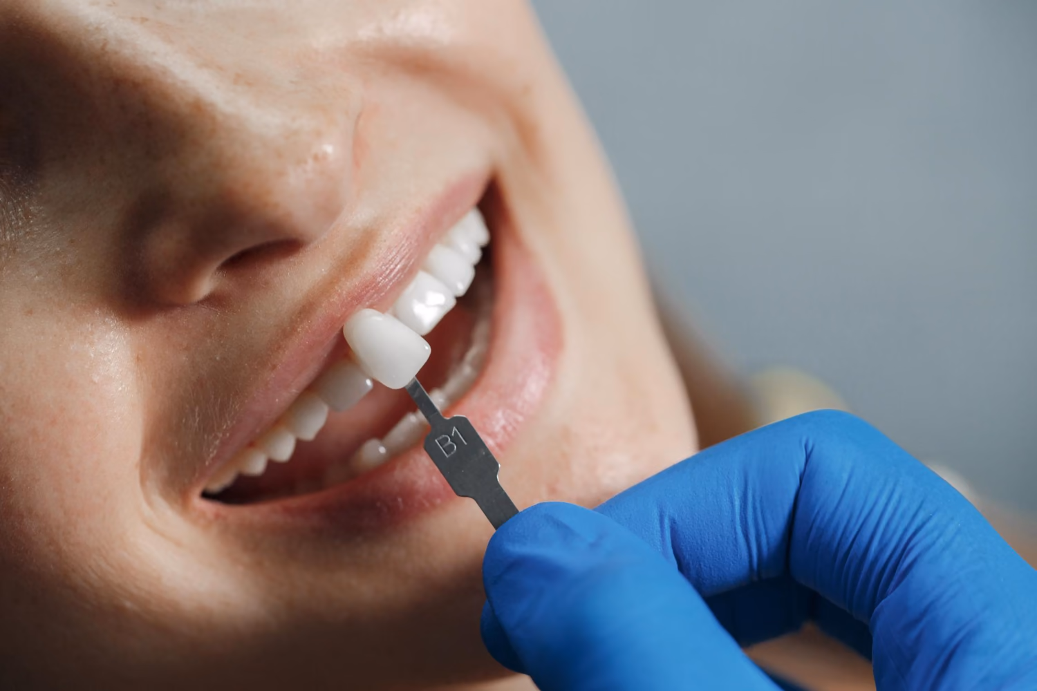 Composite veneers treatment in Burlington