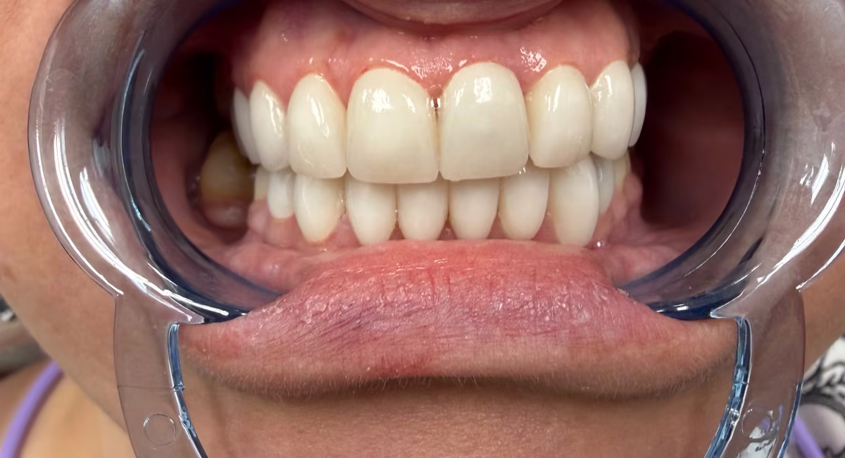 Hollywood Smile veneers and smile makeover at Burlington Dental Centre